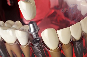 ایمپلنت های دندانی چه مزایایی دارند؟