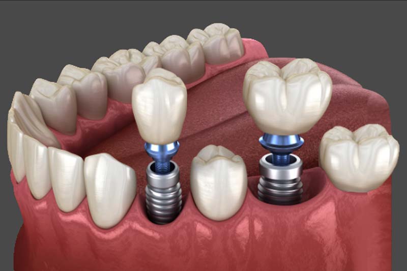 لورس :بهترین دندانپزشک ایمپلنت دندان
