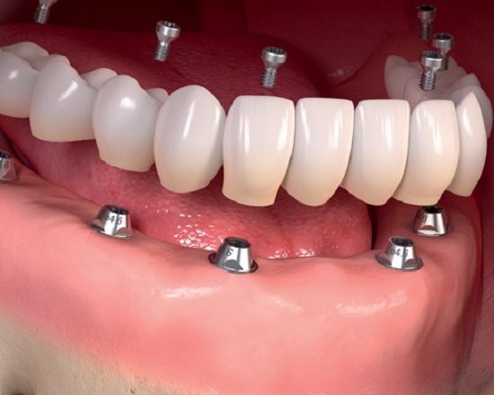 بهترین دندانپزشک ایمپلنت دندان