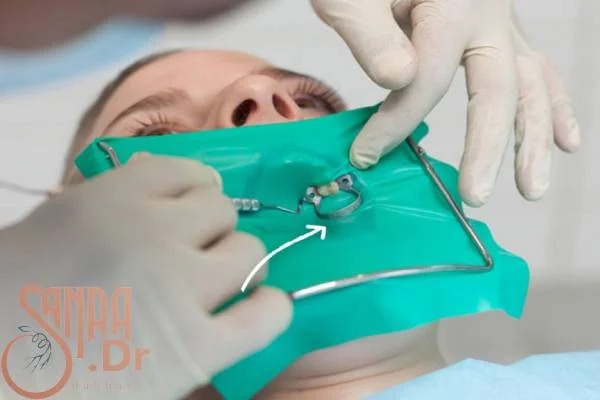 مراقبت‌های بعد از جراحی ریشه دندان